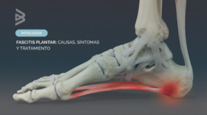 fascitis plantar