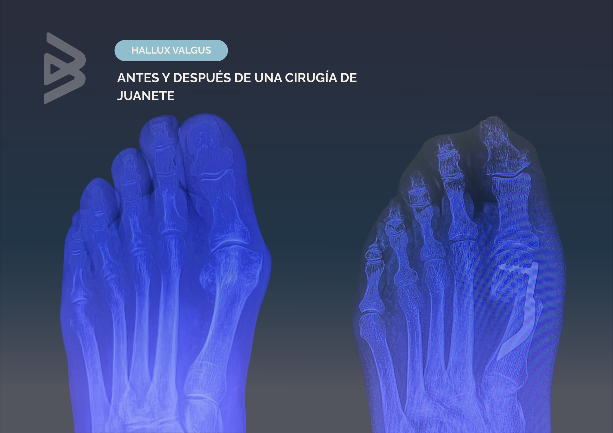 hallux valgus